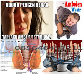 Wasir Hemoroid Stadium 3 Sembuh Berapa Lama