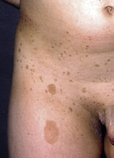 Enfermedades de la piel relacionados con el VIH / SIDA