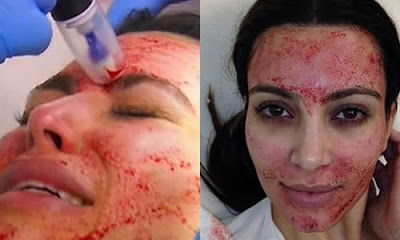 Kim Kardashian se somete a doloroso tratamiento de belleza 