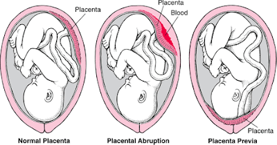 PENTINGNYA MENJAGA KESEHATAN ORGAN PLASENTA