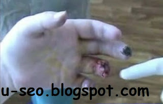 Krokodil drug,krokodil drugs,krokodil drug wiki,krokodil the drug that eats junkies,krokodil drug russia,krokodil drug effects,krokodil drug hln,krokodil drug wikipedia,krokodil drug video,krokodil drug youtube