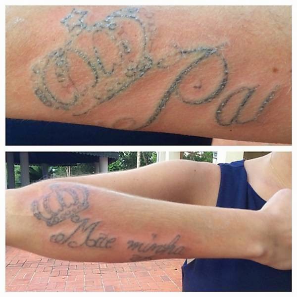 Remoção de Tatuagem Colorida a Laser Antes e Depois HD 2017