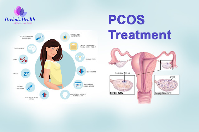 PCOS Treatment