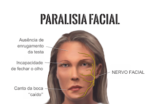 Fisioterapia e Fonoaudiologia para Paralisia Facial