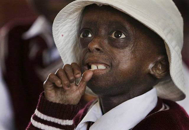 Ontlametse Falaste, Sang Gadis Cilik Berusia 12 Tahun Yang Terkena Penyakit Aneh Yang Membuat Tubuh Nya Kerdil [ www.BlogApaAja.com ]