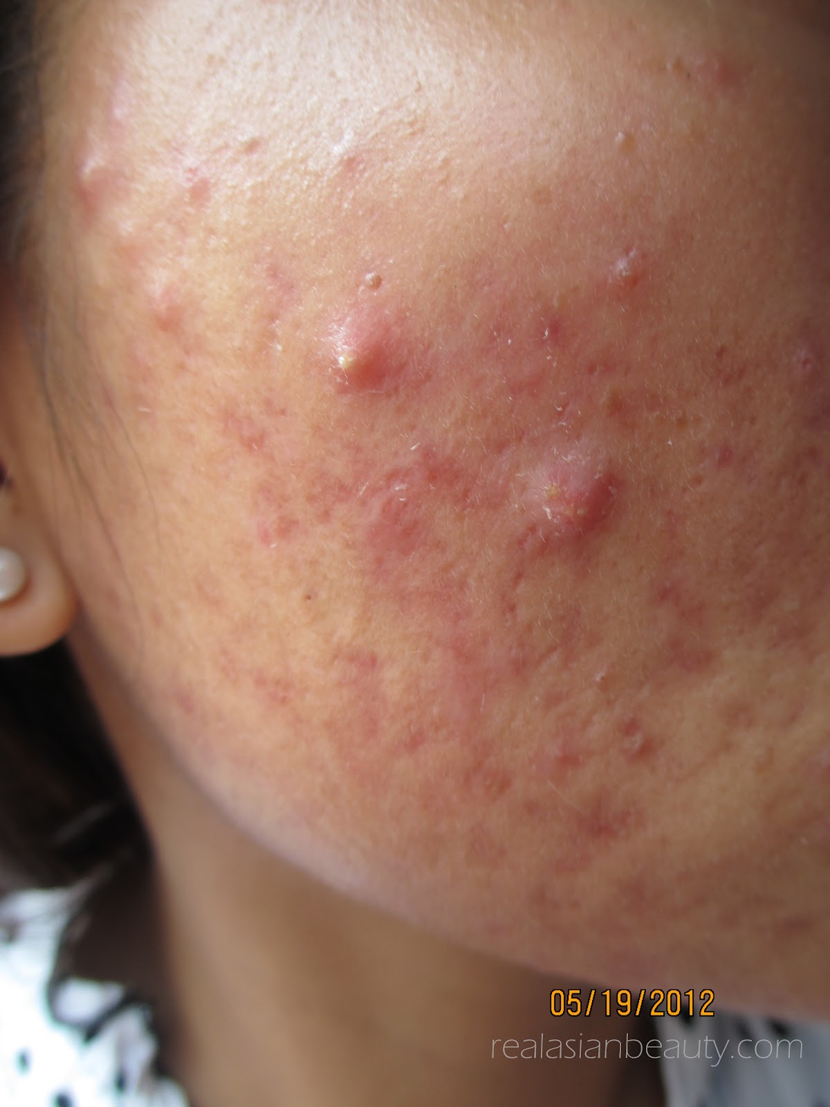 ddf acne manage remedy