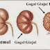 Inilah Ramuan Obat Tradisional Gagal Ginjal