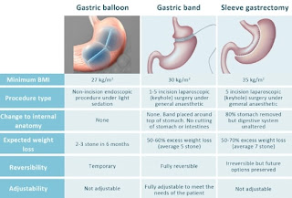 Endoscopic Sleeve Gastroplasty