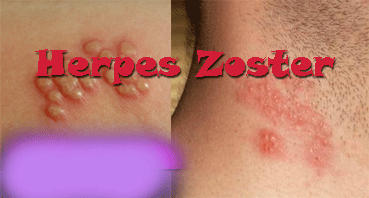 Obat Untuk Penyakit Herpes Zoster