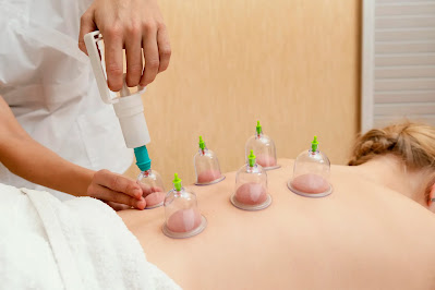 Nurse performing Cupping Therapy