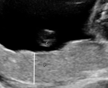 Succenturiate Lobe Placenta Ultrasound, Complications, Hemorrhage Risk