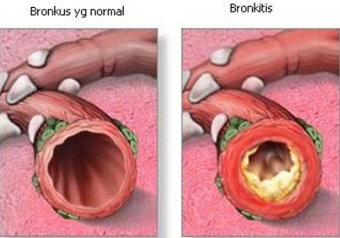 bronkitis, bronkitis kronis