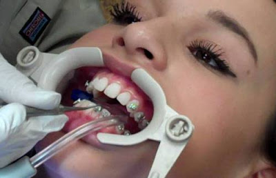 Bác sĩ Nha khoa giải đáp niềng răng có nguy hiểm không-2