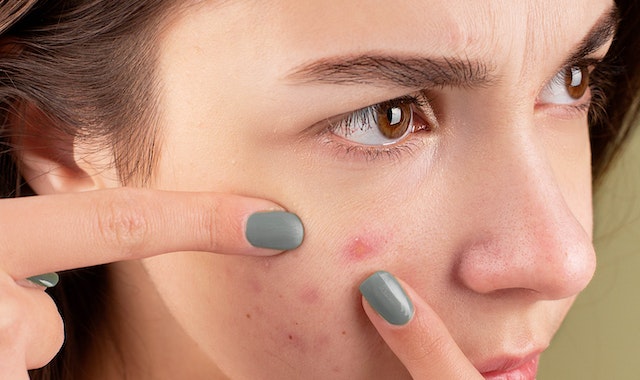 Ways to remove pimples on the face quickly