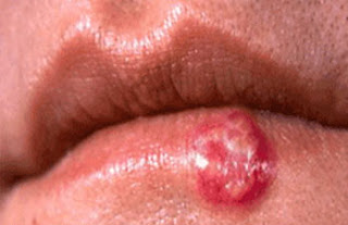 Cold Sore Contagious When Healing : Cold Sore Initial Aid For Tough Oral Herpes Cold Sores