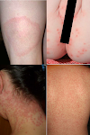 11 common causes of skin rashes