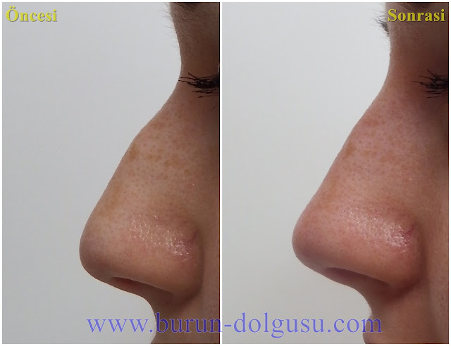 Burun Dolgusu - Dolguyla Burun estetiği - Non-surgical Nose Job In Istanbul - Dolgu İle Burun Ucu Kaldırma - Burun Ucu Dolgusu - Burun Dolgusu Fiyatı - Ameliyatsız Burun Estetiği - Burun Dolgusu Fiyatları - Dolgu İle Burun Kaldırma