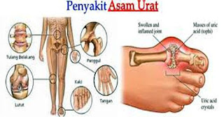 Asam urat seperti apa, pete pantangan asam urat, obat yang bagus buat asam urat, obat herbal asam urat kolesterol darah tinggi, gejala asam urat pada lengan, cara mengatasi asam urat berlebih, kadar asam urat hi, asam urat yg normal untuk perempuan, asam urat tidak boleh dipijat, air kelapa hijau bagi penderita asam urat, obat asam urat dari lobak putih