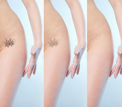 woman tattoo removal before-after