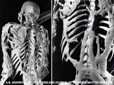 الصورة الحقيقية للهيكل العظمي لرجل مصاب بمتلازمة الرجل الحجري