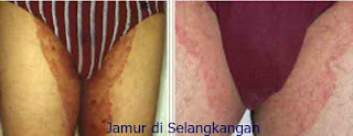 obat-gatal-scabies-di-bokong-berair-bernanah-paling-ampuh