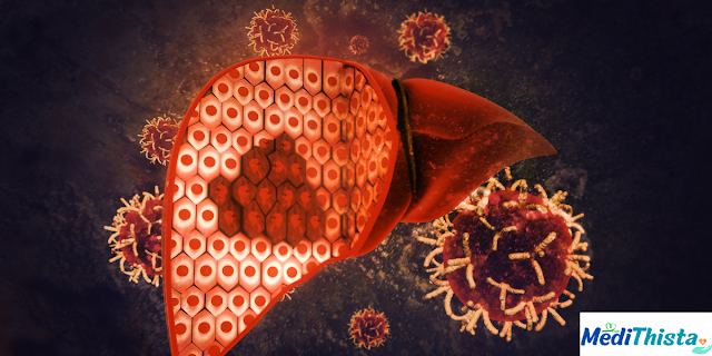 Understanding Hepatitis B : Causes, Symptoms, and Treatment