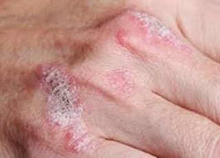 Cara Mengatasi Penyakit Dermatitis Atau Eksim, Obat Penyakit Gatal Menahun, Obat Gatal Di Kemaluan Pria, Obat Jawa Untuk Gatal, Obat Gatal Kemaluan Pria, Obat Tradisional Kulit Gatal Eksim, Obat Gatal Selangkangan Dermatitis, Gatal Eksim Pada Lengan, Obat Gatal Melepuh Berair, Obat Gatal Herbal Diminum, Obat Gatal Gatal Secara Alami, Gatal Eksim Mengelupas, Obat Gatal Atau Kurap, Obat Generik Untuk Gatal Eksim Kering, Serhat Zorlu Eksim, Cara Menyembuhkan Penyakit Kulit Eksim Basah, Obat Alami Menghilangkan Gatal Pada Wajah, Mengatasi Penyakit Eksim Kering, Gatal Gatal Di Selangkangan Kaskus, Obat Penyakit Kulit Gatal Eksim Di Apotik, Eksim Apakah Menular, Cara Mengatasi Eksim Pada Ibu Hamil, Eksim Basah, Gatal Eksim Scabies, Obat Gatal Untuk Lipatan Paha