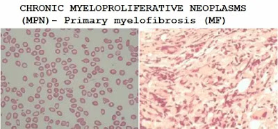 CHRONIC MYELOPROLIFERATIVE NEOPLASMS (MPN)- Primary myelofibrosis (MF)