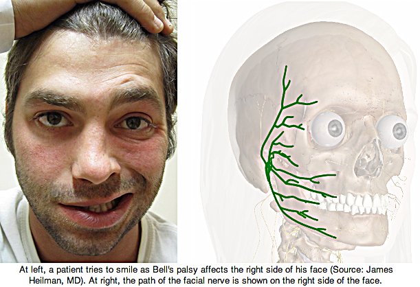 Atasi Penyakit Bell Palsy Agar Tidak Berulang Kembali