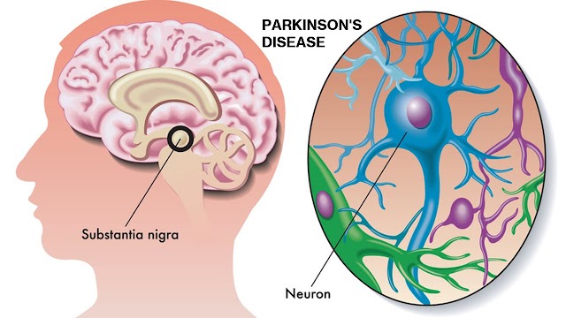 "Parkinson's Disease: Managing Symptoms and Improving Quality of Life"