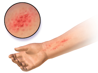 Atopic Eczema