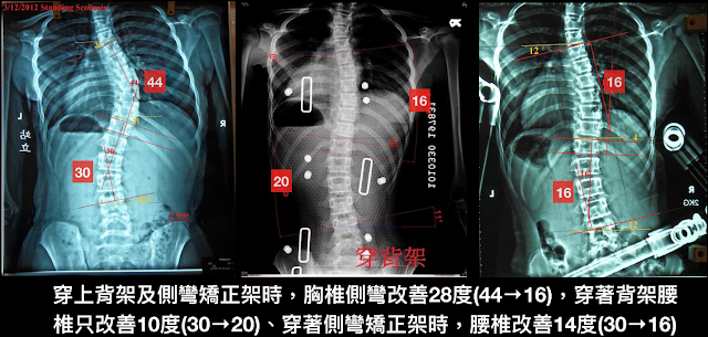 脊椎側彎矯正架, 脊椎側彎惡化, 脊椎側彎矯正, 脊椎側彎 物理治療, 脊椎側彎復健, 脊椎側彎治療