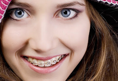 Niềng răng là giải pháp chỉnh 2 răng cửa bị vẩu hiệu quả