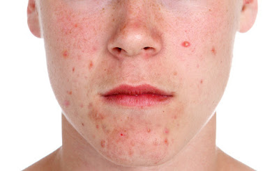 How To Clear Acne Fast