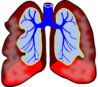 bronchite asthmatiforme chez les enfants