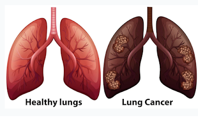 ফুসফুস ক্যান্সার( Lung cancer) কী