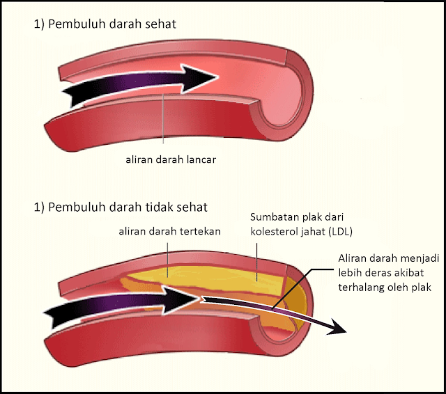  Salur Darah  Jantung Tersumbat Boleh Membawa Maut Jika 