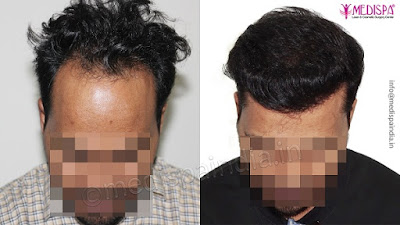 hair transplant in India