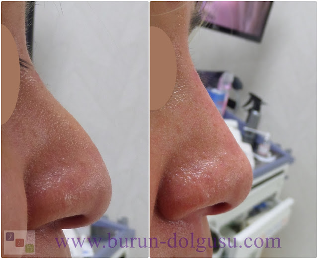 Non-surgical nose job - Non surgical nose job with filler in İstanbul - Non-surgical rhinoplasty in İstanbul - Nose tip filler augmentation in İstanbul - Non-surgical rhinoplasty in İstanbul - Nose filler injection in Turkey - The 5 Minute Nose Job in İstanbul, Turkey - Non-surgical nose job in Istanbul - Non-surgical nose job istanbul - Nose filler injection Turkey - Injectable nose job - Liquid rhinoplasty