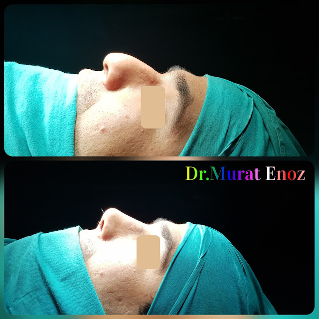 Thick Skinned Male Rhinoplasty Turkey, Nose Job For Men Istanbul