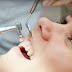 Răng đã lấy tủy có nên bọc răng sứ?