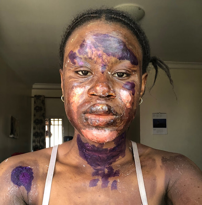 Lady shares her Transformation after suffering gas explosion months ago (Photos)