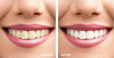 Có nên tẩy trắng răng không? Các phương pháp tẩy trắng răng phổ biến-2