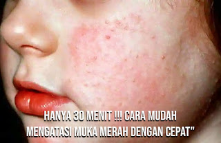 Penyebab muka merah