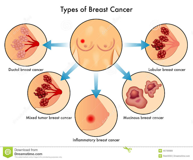  Breast Cancer Types