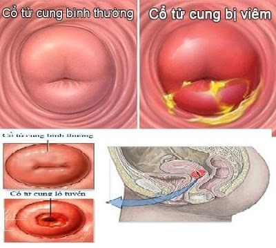 Bệnh viêm cổ tử cung ở nữ giới