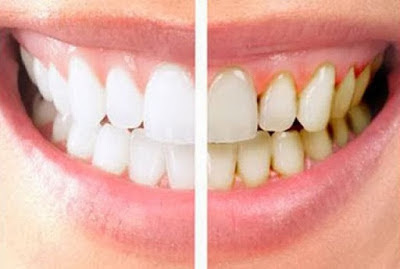 Manfaat pasta gigi nasa adalah memutihkan gigi, menghilangkan karang gigi, merawat gigi dan gusi, menghilangakan bau mulut sehingga gigi dan mulut sehat alami
