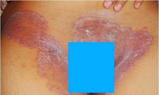 Obat Gatal Selangkangan Dermatitis Alergi Jamur Gatal Eksim Gatal Kurap 
