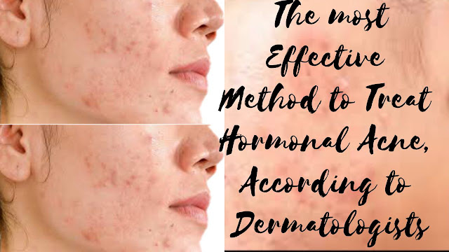 The most Effective  Method to Treat  Hormonal Acne,  According to  Dermatologists