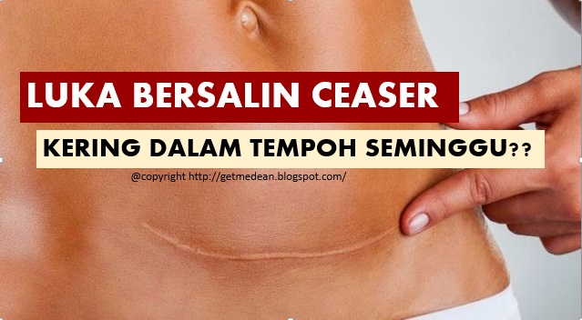 LUKA BERSALIN CAESAR KERING DALAM MASA SEMINGGU - AlmariCantik